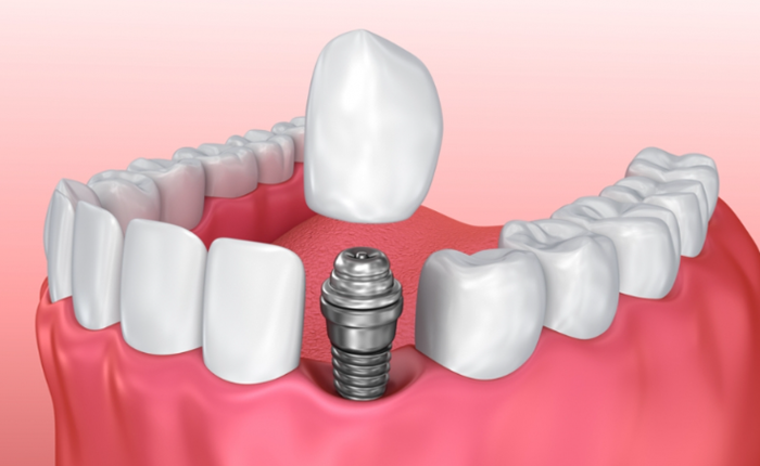 Implant completed in a month?